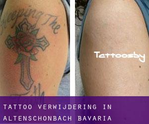 Tattoo verwijdering in Altenschönbach (Bavaria)