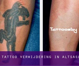 Tattoo verwijdering in Altsasu