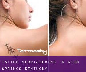 Tattoo verwijdering in Alum Springs (Kentucky)