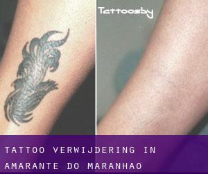 Tattoo verwijdering in Amarante do Maranhão
