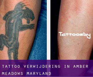 Tattoo verwijdering in Amber Meadows (Maryland)