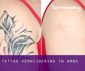 Tattoo verwijdering in Ambo
