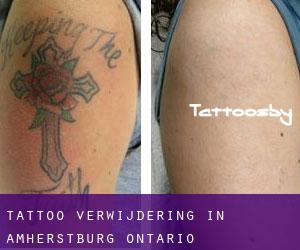 Tattoo verwijdering in Amherstburg (Ontario)