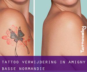 Tattoo verwijdering in Amigny (Basse-Normandie)