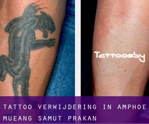Tattoo verwijdering in Amphoe Mueang Samut Prakan