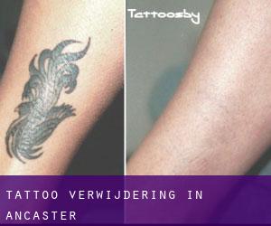 Tattoo verwijdering in Ancaster