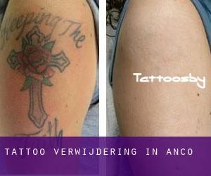 Tattoo verwijdering in Anco
