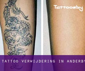 Tattoo verwijdering in Anderby