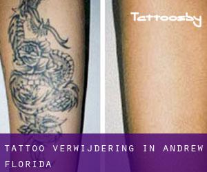Tattoo verwijdering in Andrew (Florida)