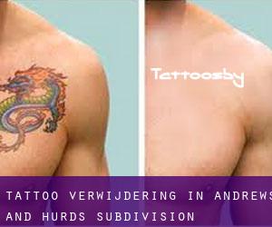 Tattoo verwijdering in Andrews and Hurds Subdivision