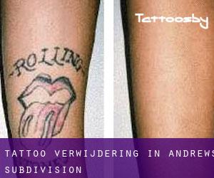 Tattoo verwijdering in Andrews Subdivision