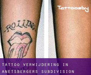Tattoo verwijdering in Anetsberger's Subdivision