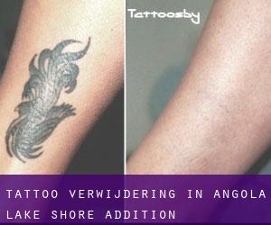 Tattoo verwijdering in Angola Lake Shore Addition