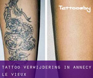 Tattoo verwijdering in Annecy-le-Vieux