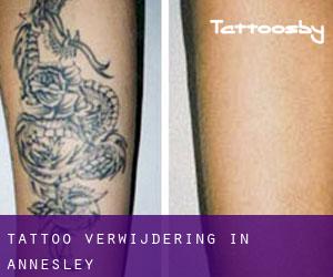 Tattoo verwijdering in Annesley