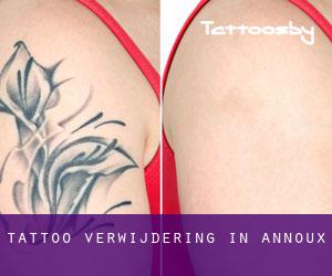 Tattoo verwijdering in Annoux