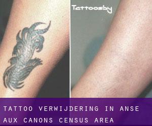 Tattoo verwijdering in Anse-aux-Canons (census area)