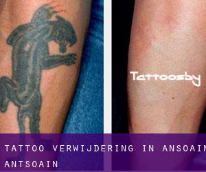 Tattoo verwijdering in Ansoáin / Antsoain