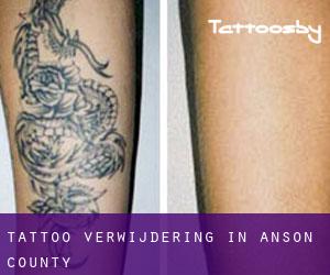 Tattoo verwijdering in Anson County