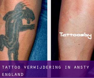 Tattoo verwijdering in Ansty (England)