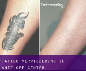 Tattoo verwijdering in Antelope Center