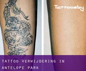 Tattoo verwijdering in Antelope Park