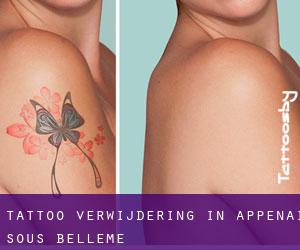 Tattoo verwijdering in Appenai-sous-Bellême