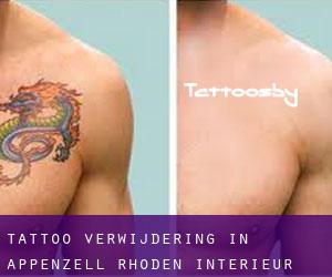 Tattoo verwijdering in Appenzell Rhoden-Intérieur