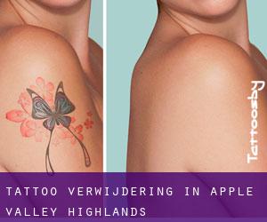 Tattoo verwijdering in Apple Valley Highlands