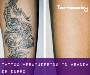 Tattoo verwijdering in Aranda de Duero