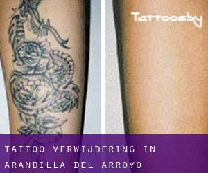 Tattoo verwijdering in Arandilla del Arroyo