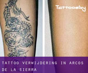 Tattoo verwijdering in Arcos de la Sierra