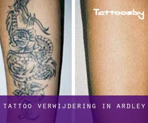 Tattoo verwijdering in Ardley