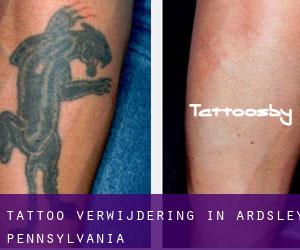 Tattoo verwijdering in Ardsley (Pennsylvania)