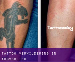 Tattoo verwijdering in Ardvorlich