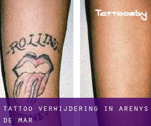 Tattoo verwijdering in Arenys de Mar