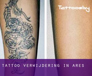 Tattoo verwijdering in Ares