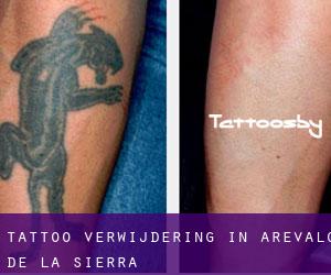 Tattoo verwijdering in Arévalo de la Sierra