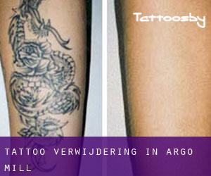 Tattoo verwijdering in Argo Mill