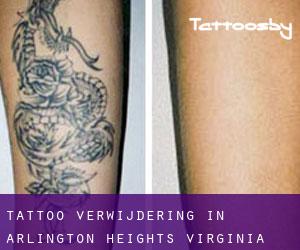 Tattoo verwijdering in Arlington Heights (Virginia)