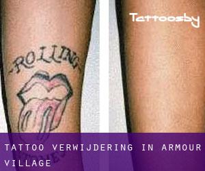 Tattoo verwijdering in Armour Village