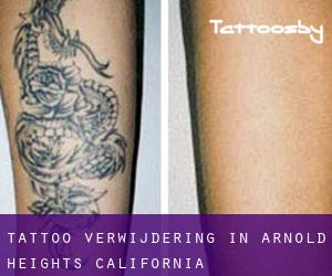 Tattoo verwijdering in Arnold Heights (California)
