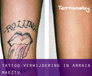 Tattoo verwijdering in Arraia-Maeztu