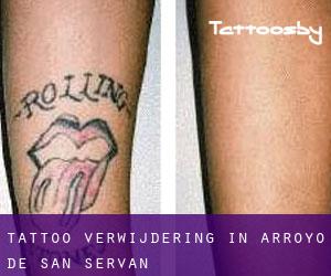 Tattoo verwijdering in Arroyo de San Serván