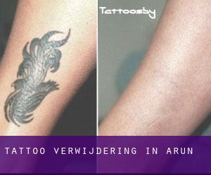 Tattoo verwijdering in Arun