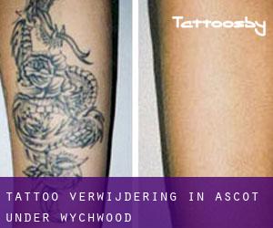 Tattoo verwijdering in Ascot under Wychwood