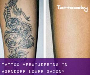 Tattoo verwijdering in Asendorf (Lower Saxony)