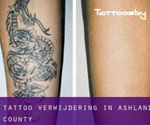 Tattoo verwijdering in Ashland County