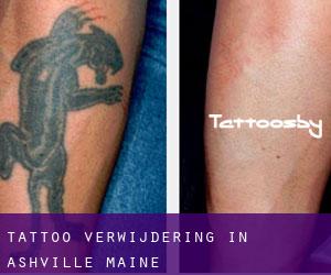 Tattoo verwijdering in Ashville (Maine)