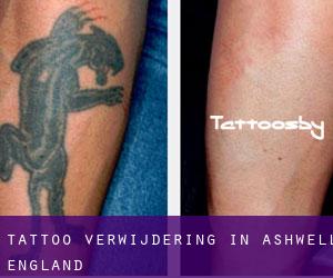 Tattoo verwijdering in Ashwell (England)